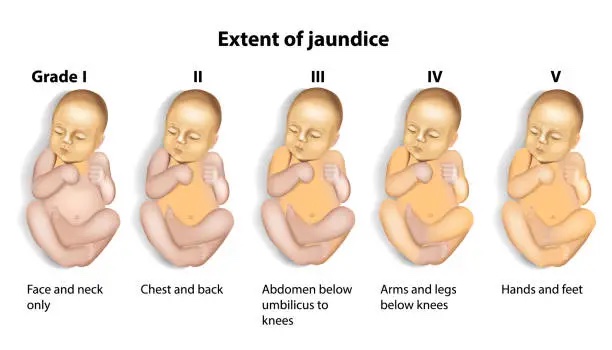 Jaundice levels